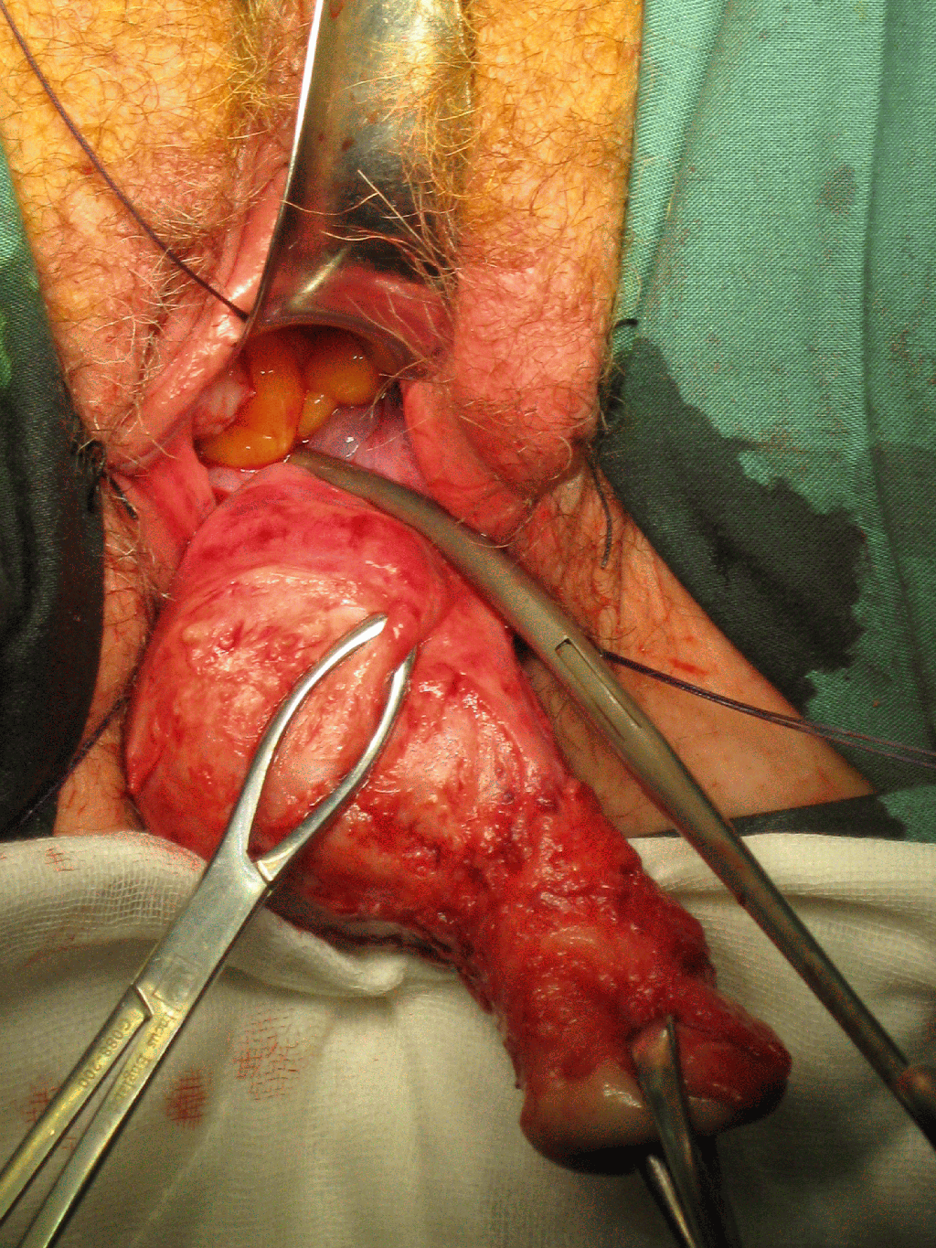 vaginal hysterectomy prolapse1